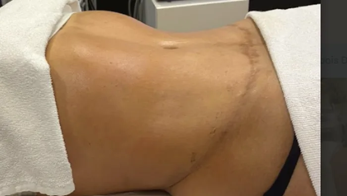 Drenagem pós-lipo na Amadora realizada com cuidado e mediante avaliação